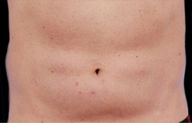 Coolsculpting Before and After 13 | Sanjay Grover MD FACS