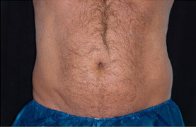 Coolsculpting Before and After 07 | Sanjay Grover MD FACS