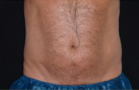 Coolsculpting Before and After 14 | Sanjay Grover MD FACS