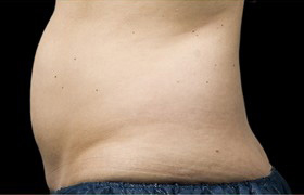 Coolsculpting Before and After 04 | Sanjay Grover MD FACS