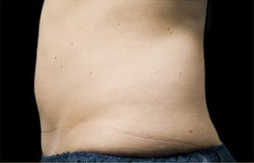 Coolsculpting Before and After 15 | Sanjay Grover MD FACS