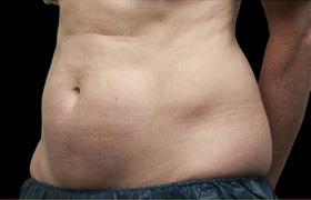 Coolsculpting Before and After | Grover Aesthetics