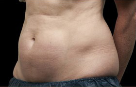 Coolsculpting Before and After | Sanjay Grover MD FACS