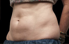 Coolsculpting Before and After 16 | Sanjay Grover MD FACS