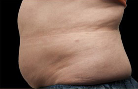 Coolsculpting Before and After | Grover Aesthetics