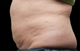 Coolsculpting Before and After | Grover Aesthetics