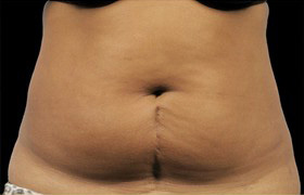 Coolsculpting Before and After 10 | Sanjay Grover MD FACS