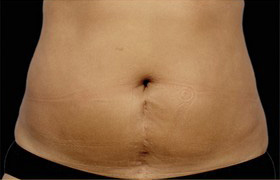 Coolsculpting Before and After | Grover Aesthetics