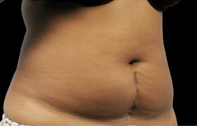 Coolsculpting Before and After 18 | Sanjay Grover MD FACS