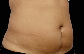 Coolsculpting Before and After 18 | Sanjay Grover MD FACS