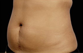 Coolsculpting Before and After 18 | Sanjay Grover MD FACS