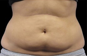 Coolsculpting Before and After 02 | Sanjay Grover MD FACS