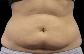 Coolsculpting Before and After 08 | Sanjay Grover MD FACS