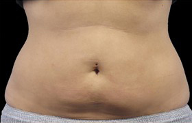 Coolsculpting Before and After 19 | Sanjay Grover MD FACS