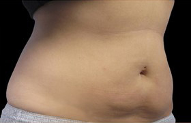 Coolsculpting Before and After 19 | Sanjay Grover MD FACS