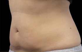 Coolsculpting Before and After 19 | Sanjay Grover MD FACS