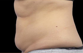 Coolsculpting Before and After 19 | Sanjay Grover MD FACS