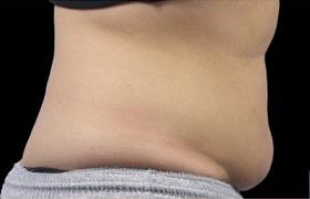 Coolsculpting Before and After 19 | Grover Aesthetics