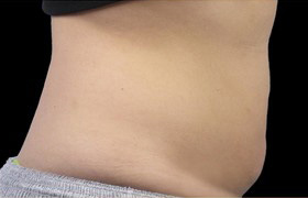 Coolsculpting Before and After 19 | Sanjay Grover MD FACS