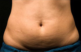 Coolsculpting Before and After 21 | Sanjay Grover MD FACS