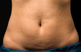 Coolsculpting Before and After 20 | Sanjay Grover MD FACS