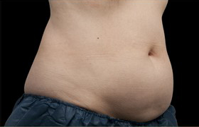 Coolsculpting Before and After 22 | Sanjay Grover MD FACS