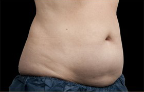 Coolsculpting Before and After | Grover Aesthetics