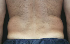 Coolsculpting Before and After 01 | Sanjay Grover MD FACS