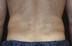 Coolsculpting Before and After 22 | Sanjay Grover MD FACS