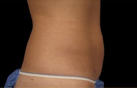 Coolsculpting Before and After | Grover Aesthetics