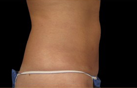 Coolsculpting Before and After 23 | Sanjay Grover MD FACS