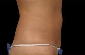Coolsculpting Before and After | Grover Aesthetics