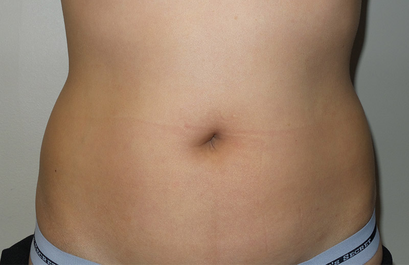 Coolsculpting Before and After 21 | Sanjay Grover MD FACS
