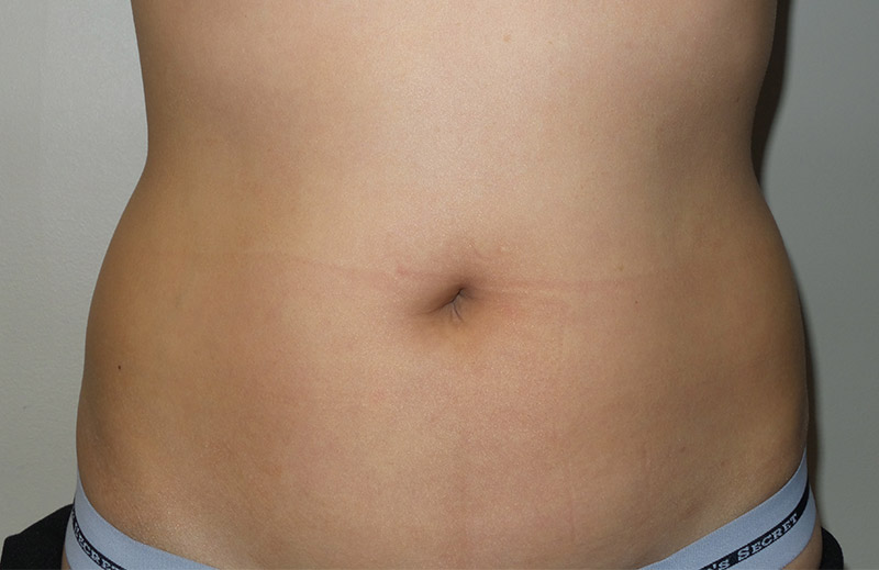 Coolsculpting Before and After | Grover Aesthetics