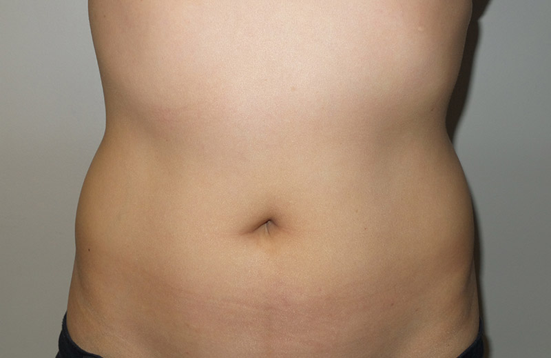 Coolsculpting Before and After | Grover Aesthetics