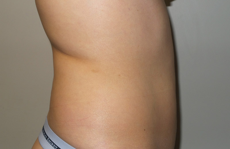 Coolsculpting Before and After 24 | Sanjay Grover MD FACS