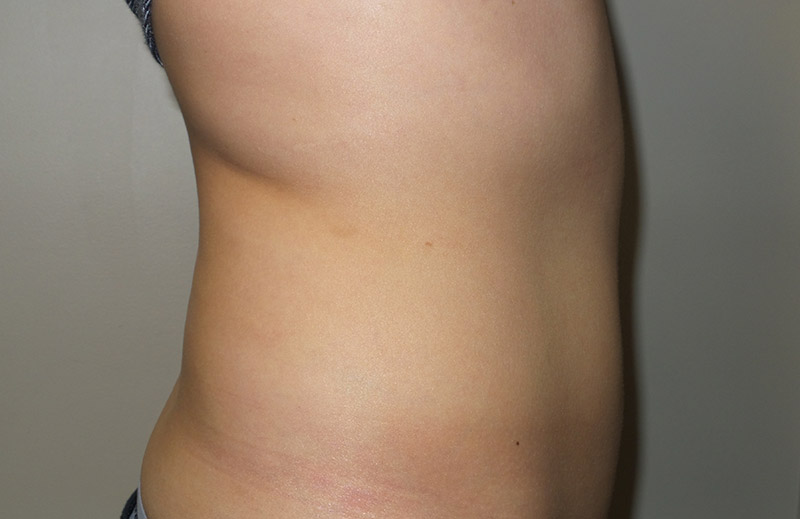 Coolsculpting Before and After 24 | Sanjay Grover MD FACS