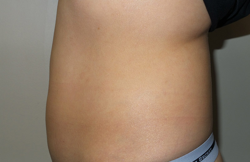 Coolsculpting Before and After 24 | Sanjay Grover MD FACS