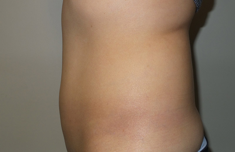 Coolsculpting Before and After 24 | Grover Aesthetics