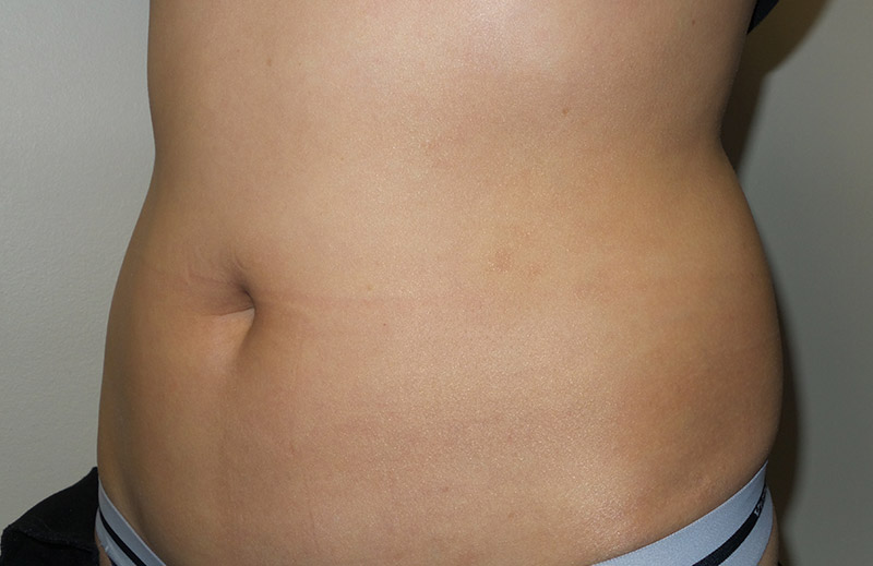 Coolsculpting Before and After 24 | Sanjay Grover MD FACS