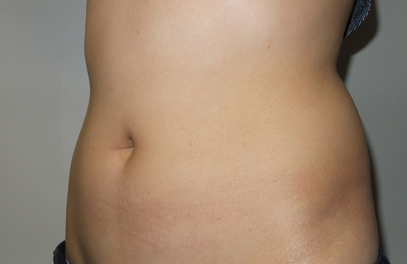 Coolsculpting Before and After 24 | Sanjay Grover MD FACS