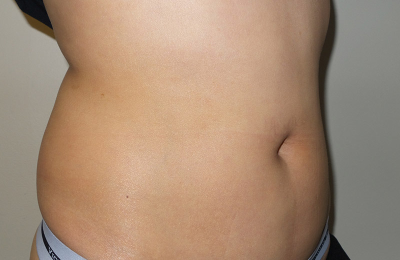 Coolsculpting Before and After 24 | Sanjay Grover MD FACS