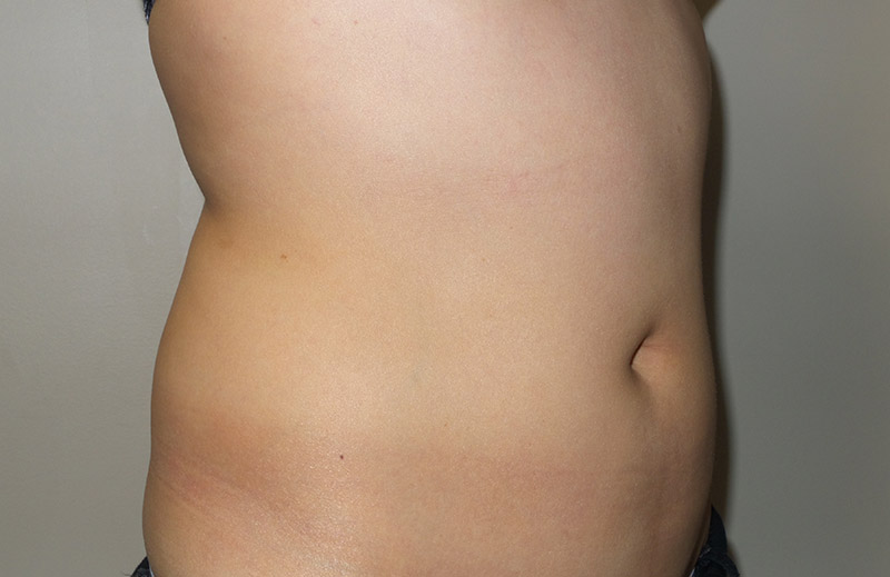 Coolsculpting Before and After 24 | Sanjay Grover MD FACS