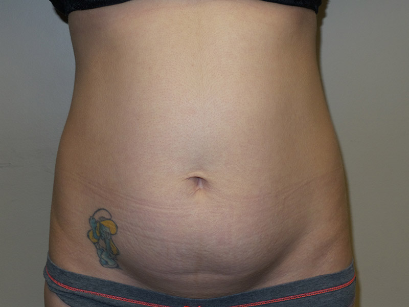 Coolsculpting Before and After 24 | Sanjay Grover MD FACS