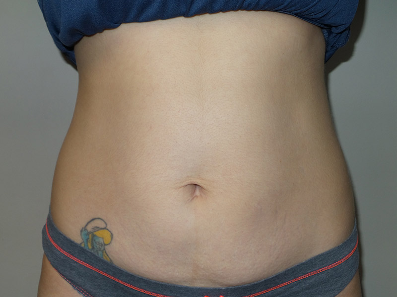 Coolsculpting Before and After 25 | Sanjay Grover MD FACS