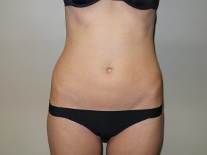 Emsculpt Before and After | Grover Aesthetics