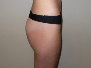 Emsculpt Before and After | Grover Aesthetics