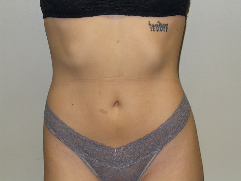 Emsculpt Before and After | Grover Aesthetics