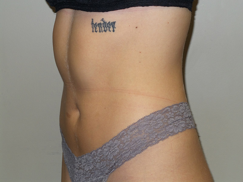 Emsculpt Before and After 03 | Grover Aesthetics