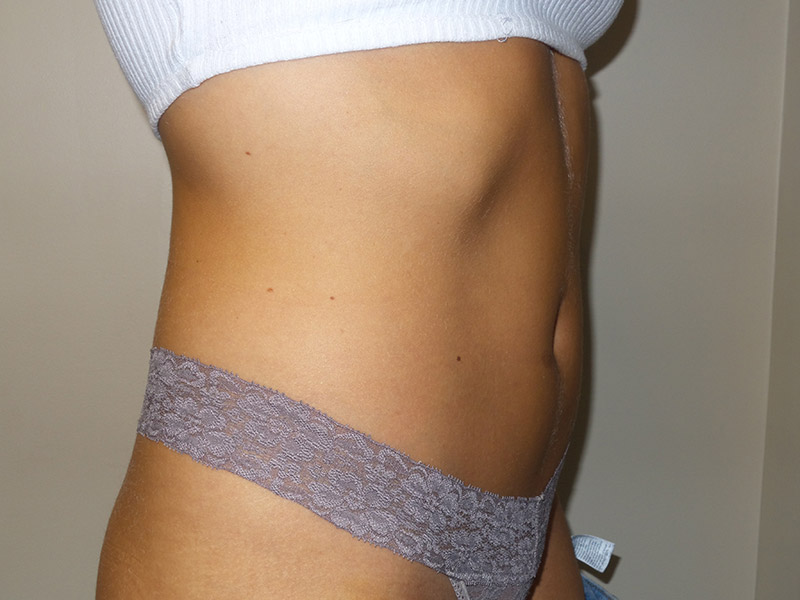 Emsculpt Before and After 03 | Grover Aesthetics